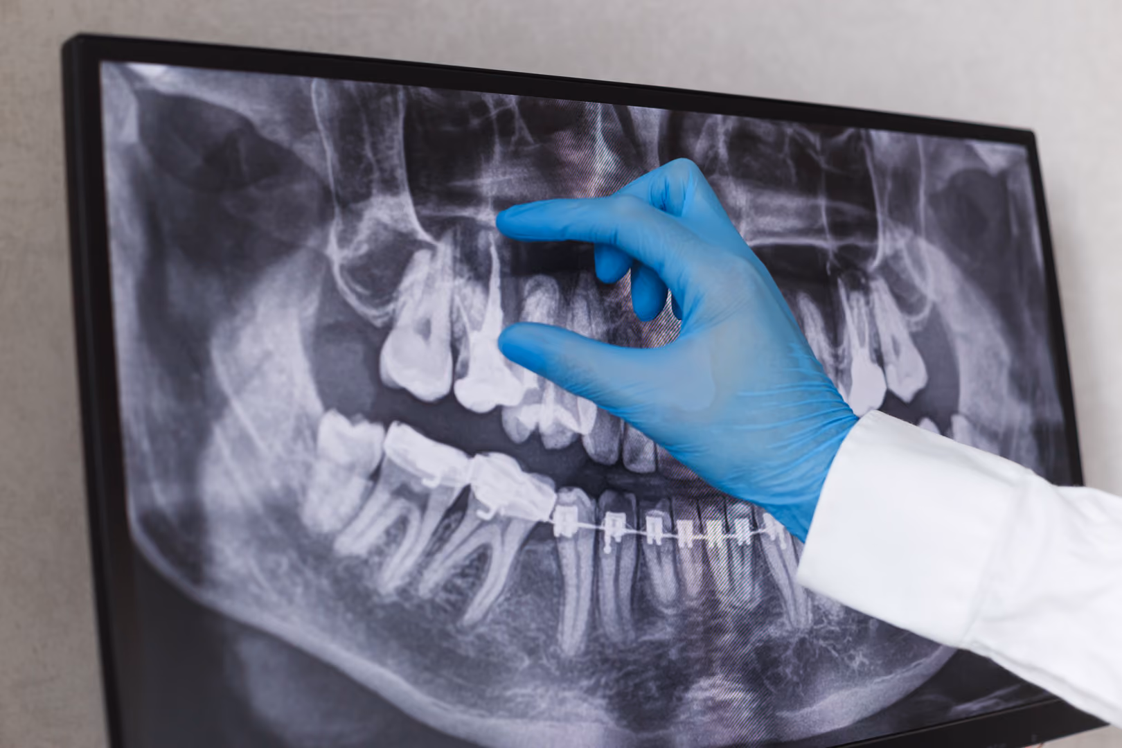 Root Canals